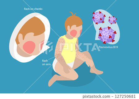 3D Isometric Flat Vector Illustration of Sick Crying Baby, Facial Reaction In Child With Fifth Disease 127250681
