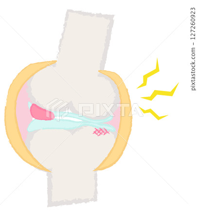 Hand-drawn illustration of joints and bones: Osteoarthritis of the knee 127260923