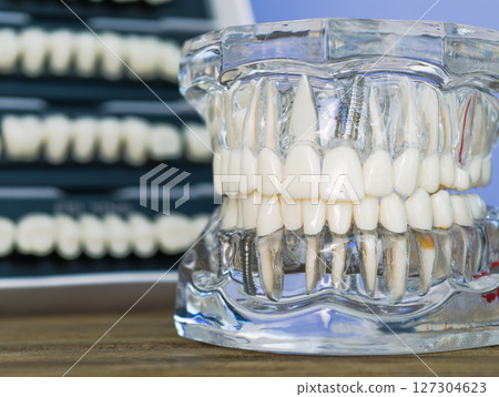 Transparent dental model showcasing implants, roots, and root canal treatment 127304623