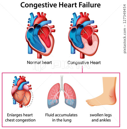 Congestive Heart Failure Medical Illustration Congestive Heart Failure Medical Illustration 127349454