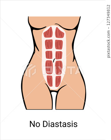 No Diastasis in a woman before and after pregnancy. The anatomy of a Woman. Woman muscular corset, body part. Vector illustration No Diastasis in a woman before and after pregnancy. The anatomy of a Woman. Woman muscular corset, body part. Vector illustration 127349812