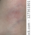 Skin insect bite symptoms close-up 127361801