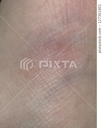 皮膚昆蟲叮咬症狀特寫 127361801