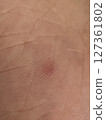 Skin insect bite symptoms close-up 127361802