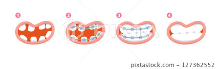 Braces teeth steps from diastema teeth to healthy teeth illustration vector design on white background. Dental care concept. Braces teeth steps from diastema teeth to healthy teeth illustration vector design on white background. Dental care concept. 127362552