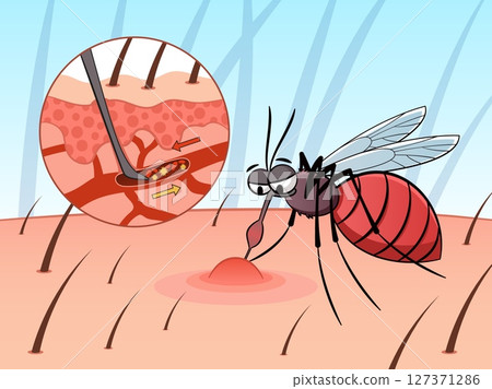 Mosquito drinks blood. Parasitic insect, cartoon character, sucking blood pest, skin surface with capillaries, scheme. Bloodsucker wound. Painful skin bite, malaria tidy vector concept 127371286
