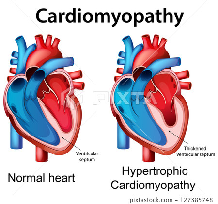 Comparison of Normal and Hypertrophic Cardiomyopathy Hearts 127385748