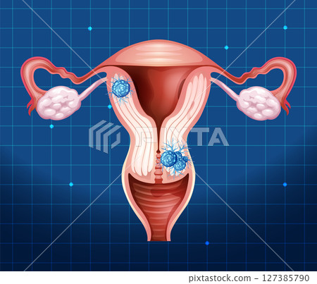 Detailed Uterus Illustration with Cancer Cells 127385790