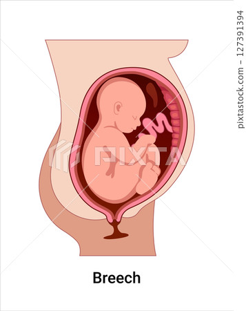 Breech baby positions in the uterus during pregnancy. Pathology. Detailed medical vector illustration. Fetus with umbilical cord and placenta. 127391394