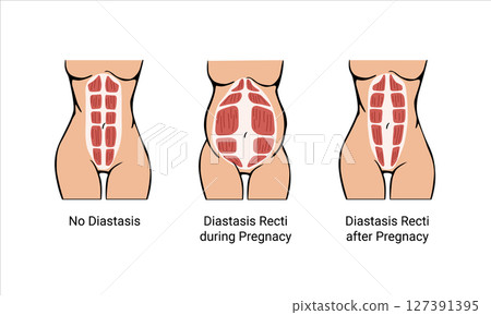 Different types of Diastasis. Diastasis in a woman before, during and after pregnancy. The anatomy of a Woman. A woman's muscular corset before and after childbirth. Vector illustration 127391395
