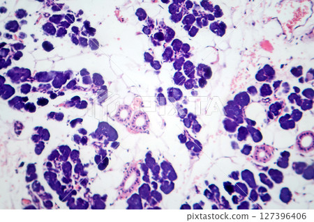 Mixed parotid tumor, photomicrograph showing epithelial and myoepithelial cell components within chondromyxoid stroma, typical of pleomorphic adenoma. 127396406