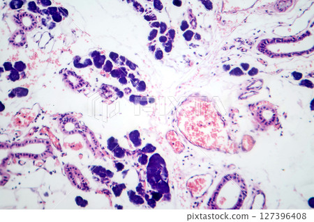 Mixed parotid tumor, photomicrograph showing epithelial and myoepithelial cell components within chondromyxoid stroma, typical of pleomorphic adenoma. Mixed parotid tumor, photomicrograph showing epithelial and myoepithelial cell components within chondromyxoid stroma, typical of pleomorphic adenoma. 127396408