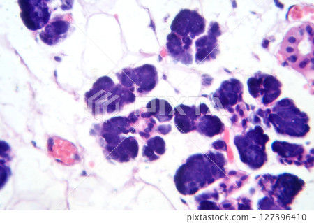 Mixed parotid tumor, photomicrograph showing epithelial and myoepithelial cell components within chondromyxoid stroma, typical of pleomorphic adenoma. Mixed parotid tumor, photomicrograph showing epithelial and myoepithelial cell components within chondromyxoid stroma, typical of pleomorphic adenoma. 127396410