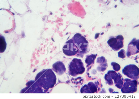 Mixed parotid tumor, photomicrograph showing epithelial and myoepithelial cell components within chondromyxoid stroma, typical of pleomorphic adenoma. Mixed parotid tumor, photomicrograph showing epithelial and myoepithelial cell components within chondromyxoid stroma, typical of pleomorphic adenoma. 127396412