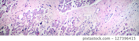 Skeletal muscle atrophy, photomicrograph showing decreased fiber size with increased spacing between them, reduced myofibrils, increased endomysial connective tissue with fatty infiltration 127396415