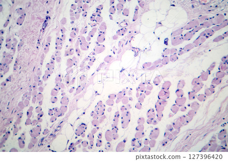Skeletal muscle atrophy, photomicrograph showing decreased fiber size with increased spacing between them, reduced myofibrils, increased endomysial connective tissue with fatty infiltration 127396420