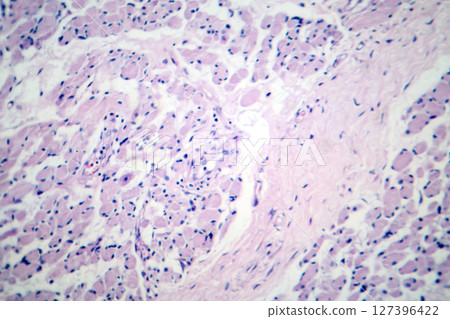 Skeletal muscle atrophy, photomicrograph showing decreased fiber size with increased spacing between them, reduced myofibrils, increased endomysial connective tissue with fatty infiltration 127396422