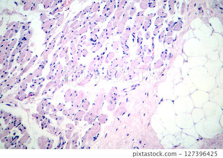 Skeletal muscle atrophy, photomicrograph showing decreased fiber size with increased spacing between them, reduced myofibrils, increased endomysial connective tissue with fatty infiltration Skeletal muscle atrophy, photomicrograph showing decreased fiber size with increased spacing between them, reduced myofibrils, increased endomysial connective tissue with fatty infiltration 127396425