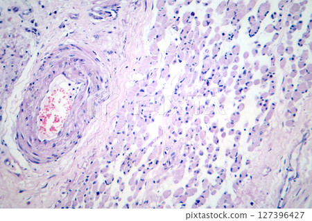 Skeletal muscle atrophy, photomicrograph showing decreased fiber size with increased spacing between them, reduced myofibrils, increased endomysial connective tissue with fatty infiltration Skeletal muscle atrophy, photomicrograph showing decreased fiber size with increased spacing between them, reduced myofibrils, increased endomysial connective tissue with fatty infiltration 127396427