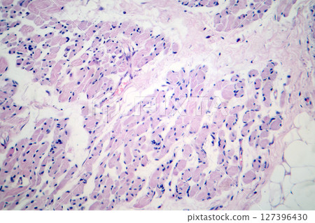 Skeletal muscle atrophy, photomicrograph showing decreased fiber size with increased spacing between them, reduced myofibrils, increased endomysial connective tissue with fatty infiltration Skeletal muscle atrophy, photomicrograph showing decreased fiber size with increased spacing between them, reduced myofibrils, increased endomysial connective tissue with fatty infiltration 127396430