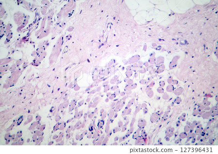 Skeletal muscle atrophy, photomicrograph showing decreased fiber size with increased spacing between them, reduced myofibrils, increased endomysial connective tissue with fatty infiltration Skeletal muscle atrophy, photomicrograph showing decreased fiber size with increased spacing between them, reduced myofibrils, increased endomysial connective tissue with fatty infiltration 127396431