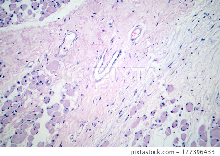 Skeletal muscle atrophy, photomicrograph showing decreased fiber size with increased spacing between them, reduced myofibrils, increased endomysial connective tissue with fatty infiltration 127396433