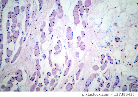 Skeletal muscle atrophy, photomicrograph showing decreased fiber size with increased spacing between them, reduced myofibrils, increased endomysial connective tissue 127396435