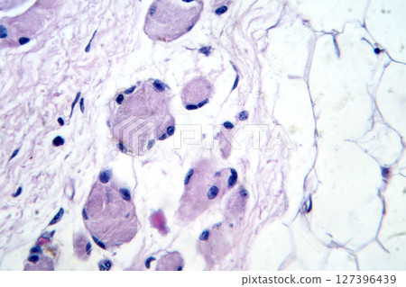 Skeletal muscle atrophy, photomicrograph showing decreased fiber size with increased spacing between them, reduced myofibrils, increased endomysial connective tissue with fatty infiltration Skeletal muscle atrophy, photomicrograph showing decreased fiber size with increased spacing between them, reduced myofibrils, increased endomysial connective tissue with fatty infiltration 127396439