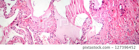 Red hepatization stage of lobar pneumonia, photomicrograph showing alveolar exudate with red cells, neutrophils, and fibrin strands 127396452