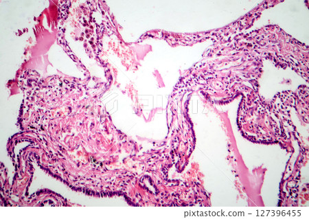 Red hepatization stage of lobar pneumonia, photomicrograph showing alveolar exudate with red cells, neutrophils, and fibrin strands Red hepatization stage of lobar pneumonia, photomicrograph showing alveolar exudate with red cells, neutrophils, and fibrin strands 127396455