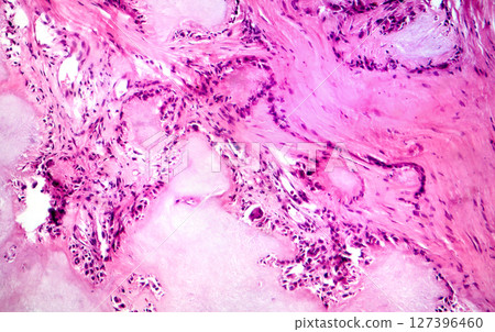 Gout tophus, photomicrograph showing amorphous, eosinophilic material with a foreign-body giant cell reaction and inflammation 127396460