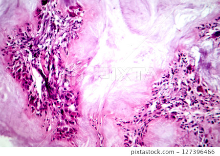 Gout tophus, photomicrograph showing amorphous, eosinophilic material with a foreign-body giant cell reaction and inflammation Gout tophus, photomicrograph showing amorphous, eosinophilic material with a foreign-body giant cell reaction and inflammation 127396466