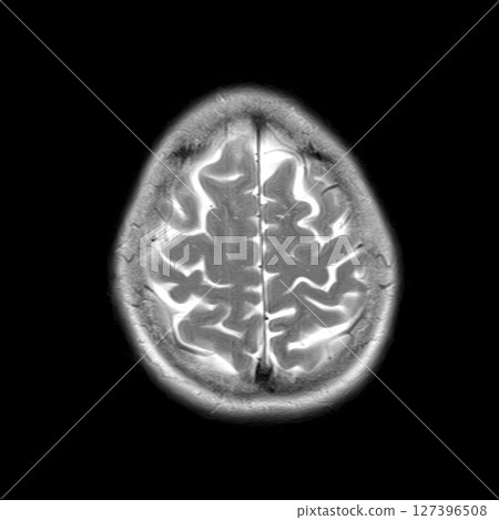 Axial T2-weighted MRI of a 44-year-old patient showing normal brain structures. No visible abnormalities. High signal in CSF and clear cortical sulci 127396508