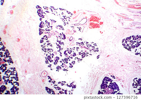 Mixed parotid tumor, photomicrograph showing epithelial and myoepithelial cell components within chondromyxoid stroma, typical of pleomorphic adenoma. Mixed parotid tumor, photomicrograph showing epithelial and myoepithelial cell components within chondromyxoid stroma, typical of pleomorphic adenoma. 127396716