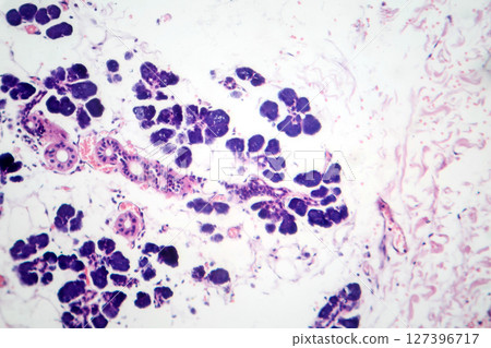 Mixed parotid tumor, photomicrograph showing epithelial and myoepithelial cell components within chondromyxoid stroma, typical of pleomorphic adenoma. 127396717