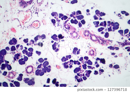 Mixed parotid tumor, photomicrograph showing epithelial and myoepithelial cell components within chondromyxoid stroma, typical of pleomorphic adenoma. Mixed parotid tumor, photomicrograph showing epithelial and myoepithelial cell components within chondromyxoid stroma, typical of pleomorphic adenoma. 127396718