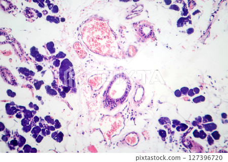 Mixed parotid tumor, photomicrograph showing epithelial and myoepithelial cell components within chondromyxoid stroma, typical of pleomorphic adenoma. 127396720