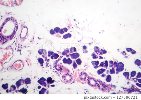 Mixed parotid tumor, photomicrograph showing epithelial and myoepithelial cell components within chondromyxoid stroma, typical of pleomorphic adenoma. Mixed parotid tumor, photomicrograph showing epithelial and myoepithelial cell components within chondromyxoid stroma, typical of pleomorphic adenoma. 127396721