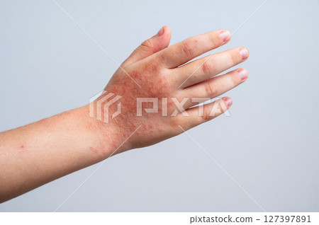 Red rashes from the Coxsackie virus on a child hand close up. Chicken pox and allergy symptoms on skin on children's body on a white background 127397891
