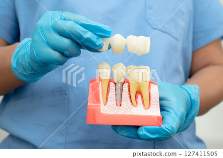 Dental implant, artificial tooth roots into jaw, root canal of dental treatment, gum disease, teeth model for dentist studying about dentistry. 127411505