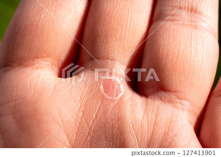 Skin condition close-up human hand medical indoor setting macro view healing process Skin condition close-up human hand medical indoor setting macro view healing process 127413901