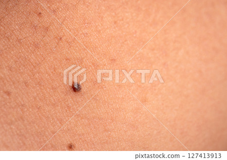 Skin health monitoring understanding moles skin medical context close-up health awareness 127413913