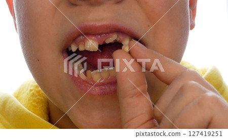 The child opens his mouth and shows a freshly pulled milk tooth 127419251