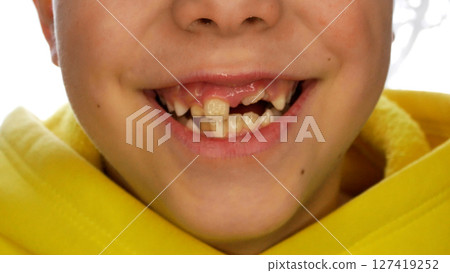 The smile of a child with milk teeth that have partially fallen out. Change of teeth in children. 127419252