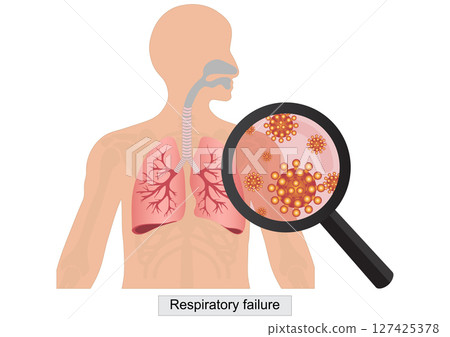 Respiratory failure is a serious condition. 127425378