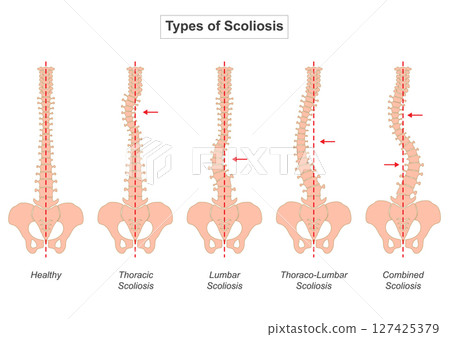 Scoliosis is a condition characterized by an abnormal curvature of the spine. 127425379