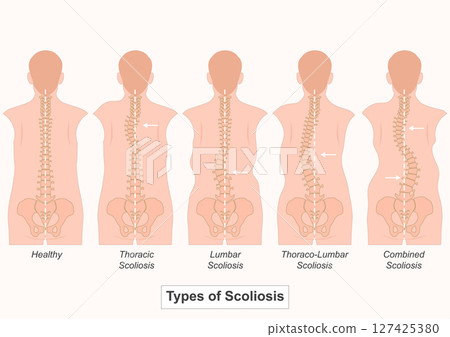 Scoliosis is a condition where the spine curves abnormally to the side. Scoliosis is a condition where the spine curves abnormally to the side. 127425380