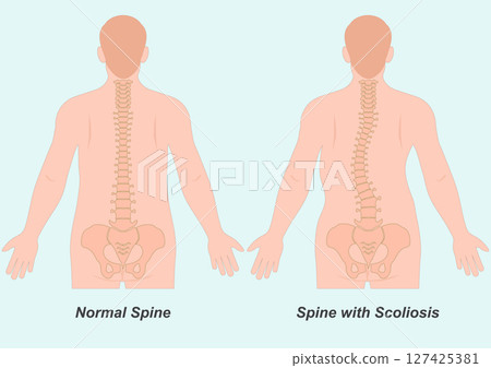 Scoliosis is a side to side curve of spine. Scoliosis is a side to side curve of spine. 127425381