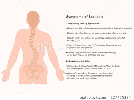 Symptoms of Scoliosis is a sideways curving and twisting of the spine. Symptoms of Scoliosis is a sideways curving and twisting of the spine. 127425384