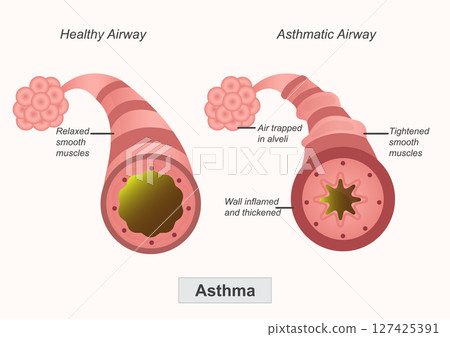 Asthma is a chronic respiratory condition where the airways in the lungs narrow. 127425391